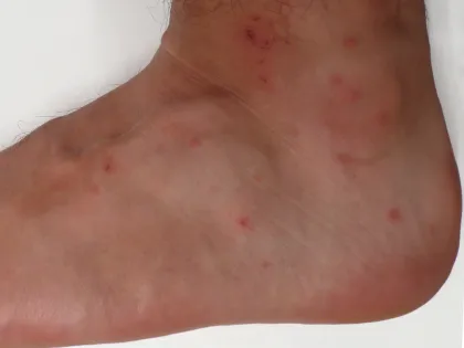 Chigger bites: clusters of small red, itchy bumps around the ankle
